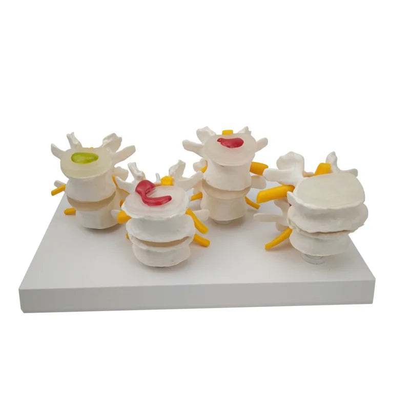 4-stage Pathological Human Lumbar Spine Anatomy Model Medical Science Teaching Resources
