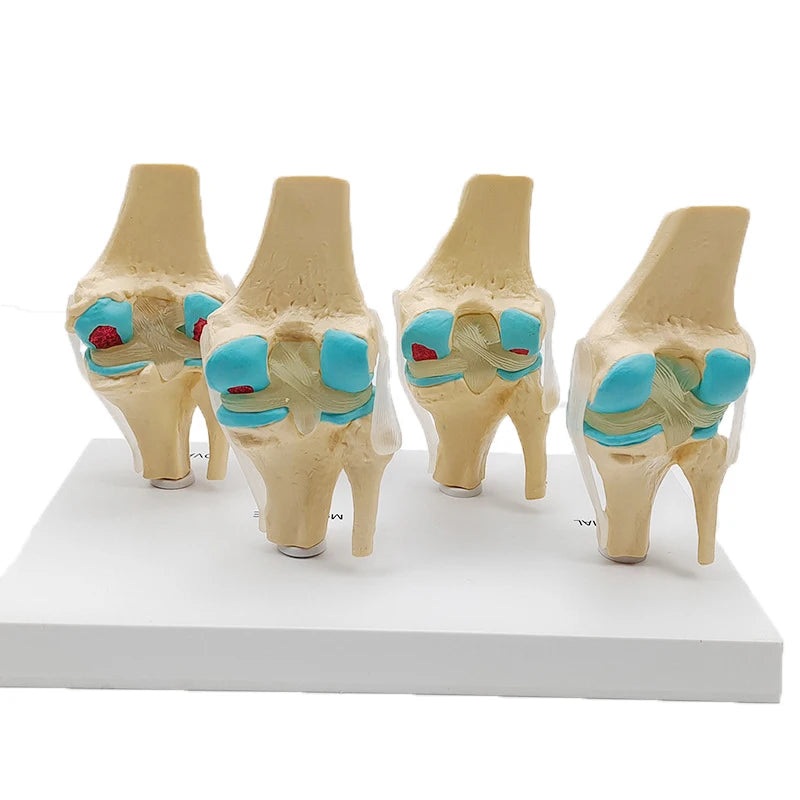 Four-stage Human Pathological Knee Joint Anatomy Model Medical Science Teaching Resources