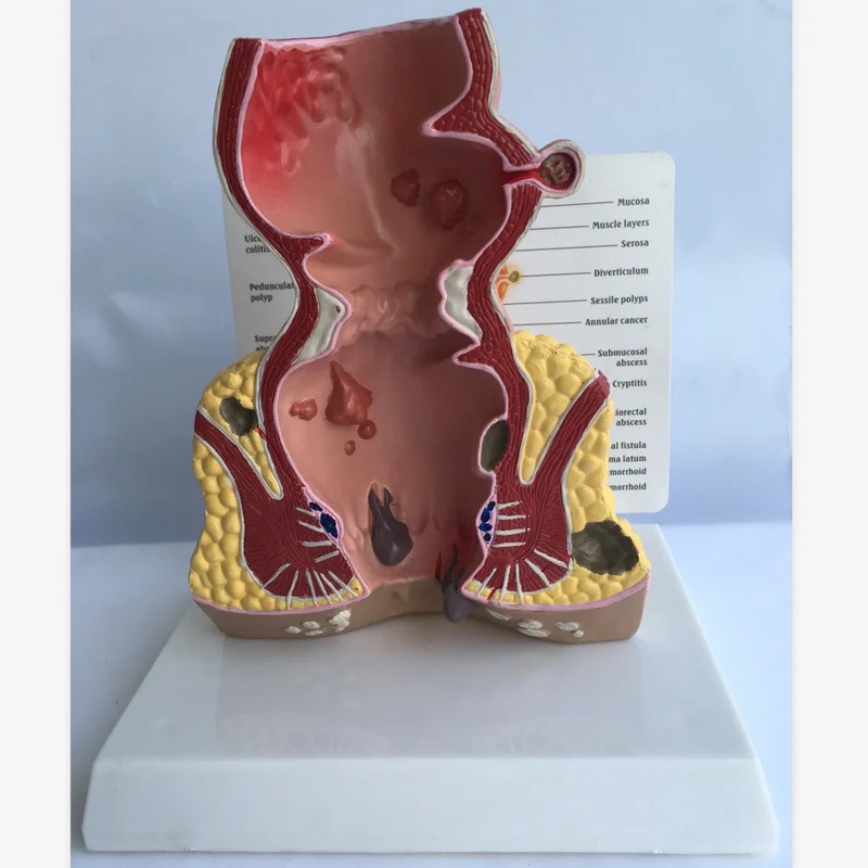 Pathologies Model of Rectum Model Rectum Anatomical model