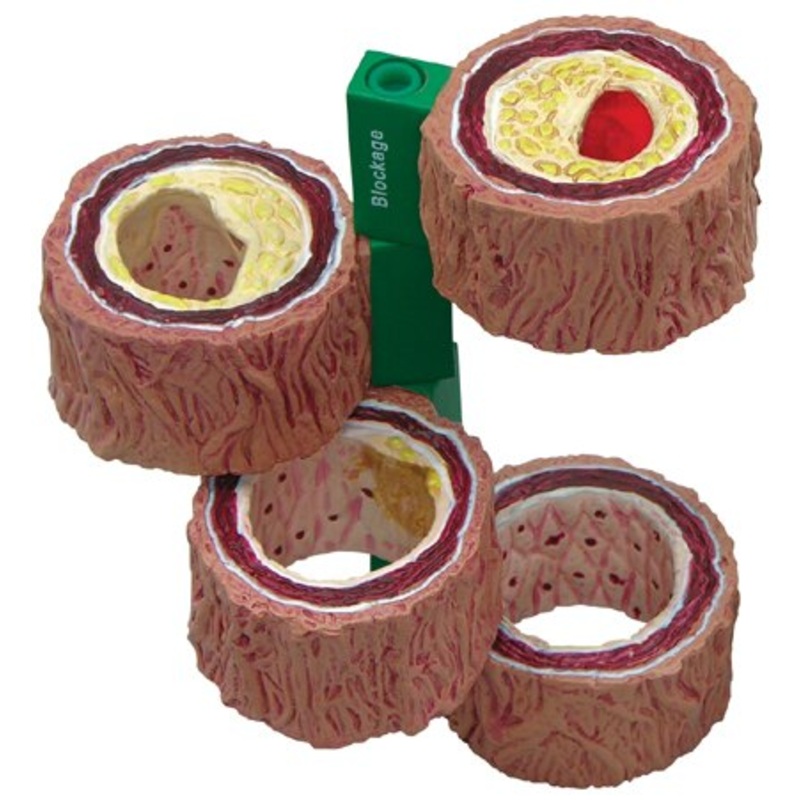 4-Stage Cross Section Human Artery Atherosclerosis Anatomical Mode Thrombotic process