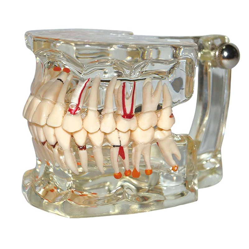 Dental Model Teeth Pathology Model With Half Implant Show Clearly the Original Shape and the Whole Structure
