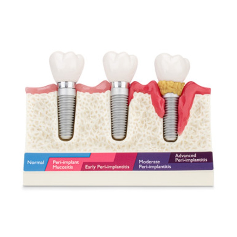 Peri-Implant Disease Model