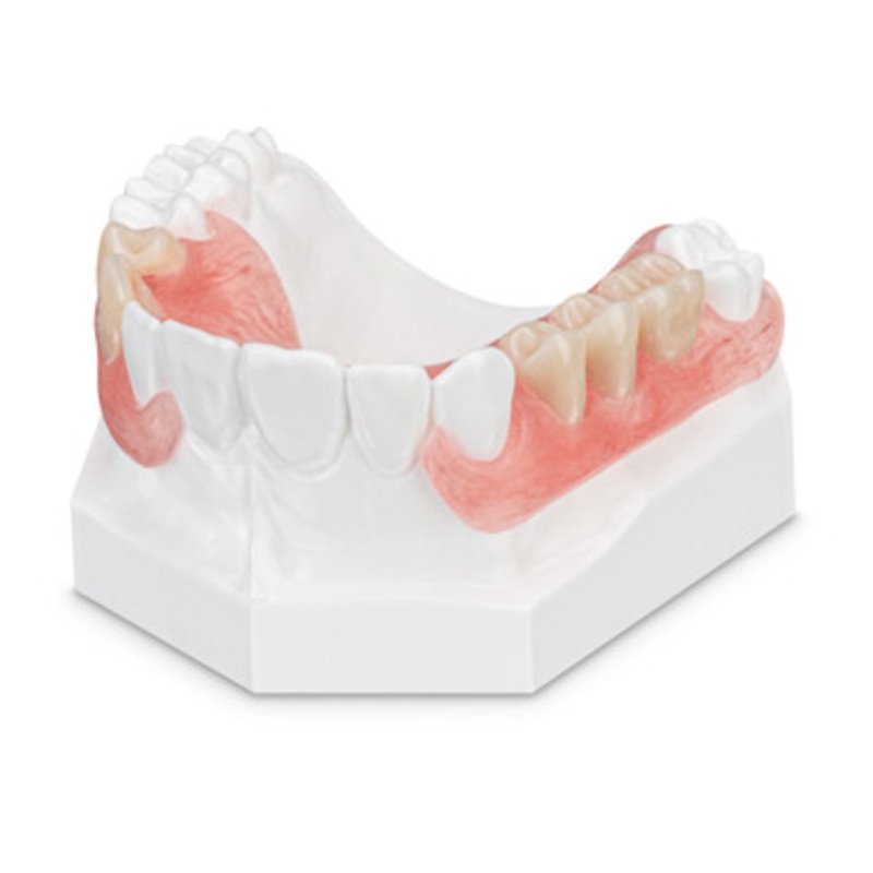 Flexible Upper Partial Denture Model