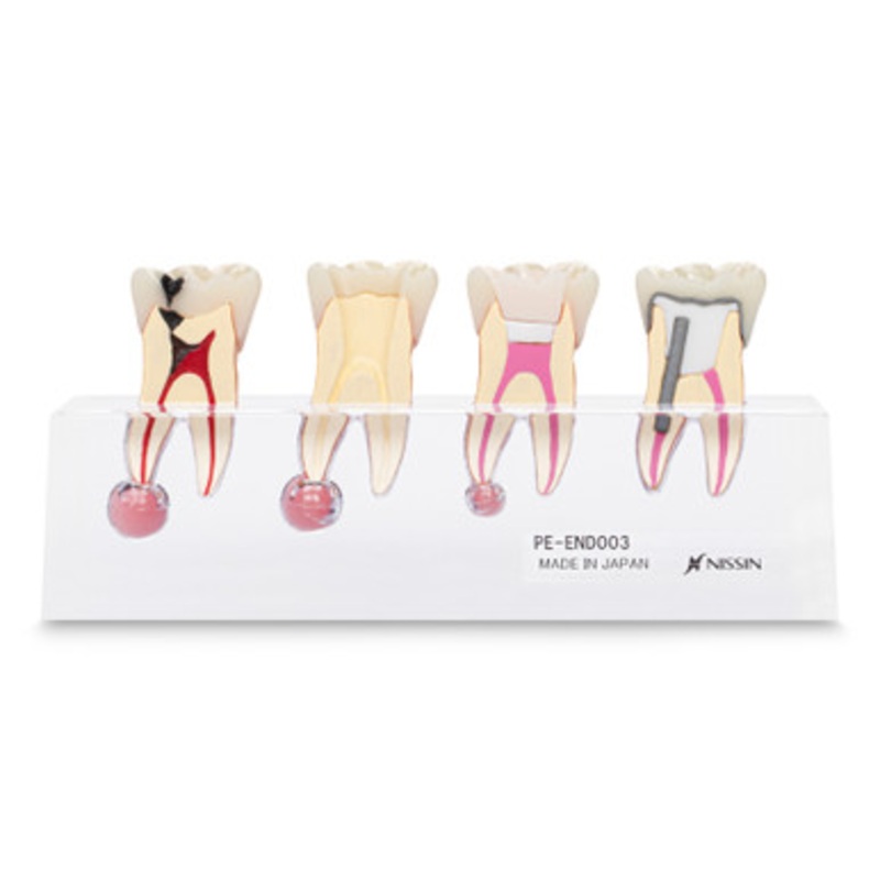 Endodontic Treament Model