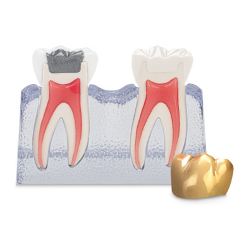 Pre/Post Treatment Cracked Tooth Model