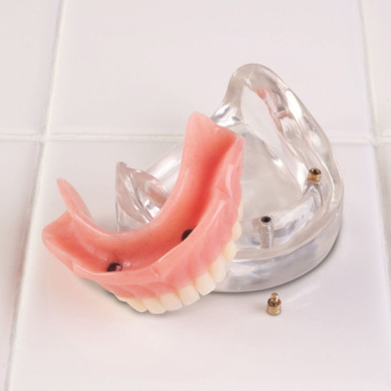 LOC-2 Lower Locator Two Implant Model