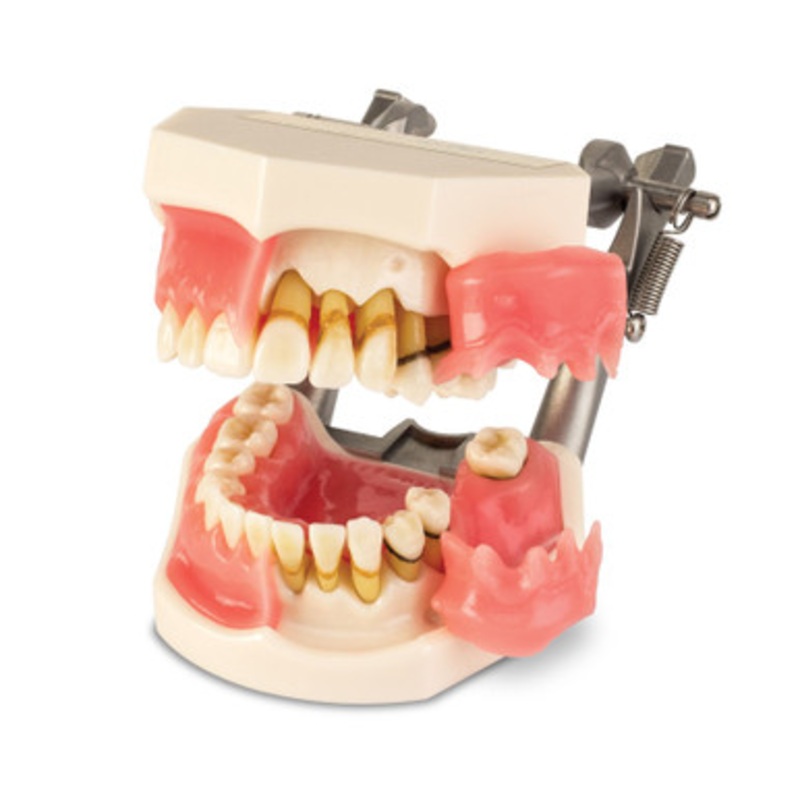 Periodontal Disease Model
