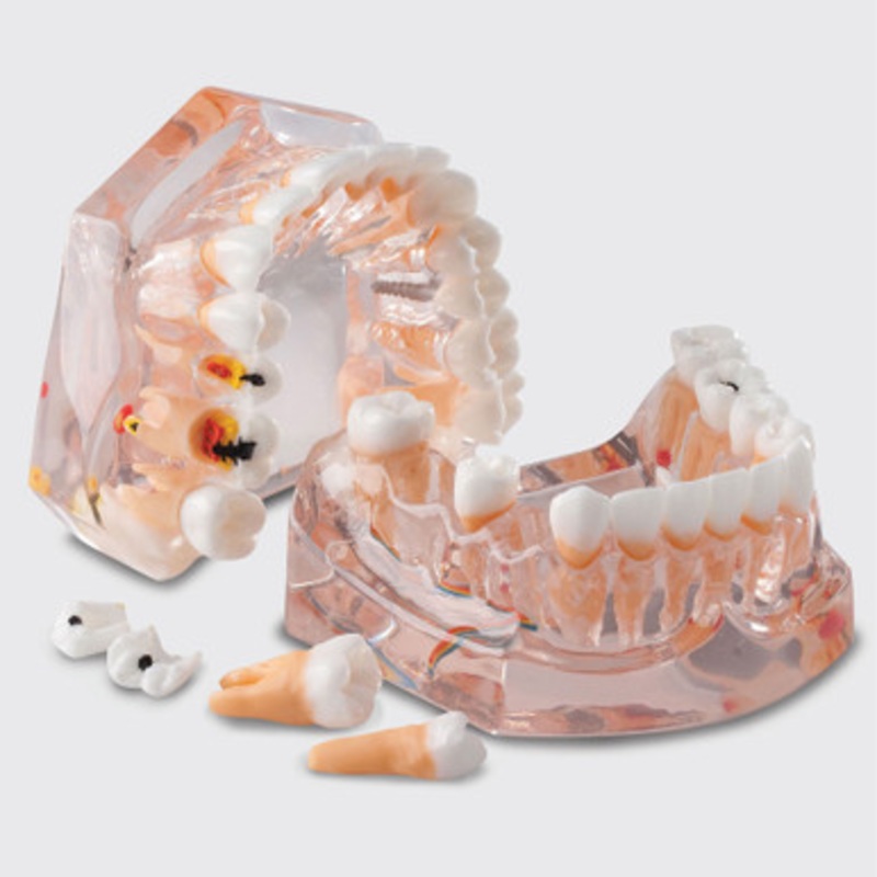 Enlarged Model For Hygiene And Caries Evolution