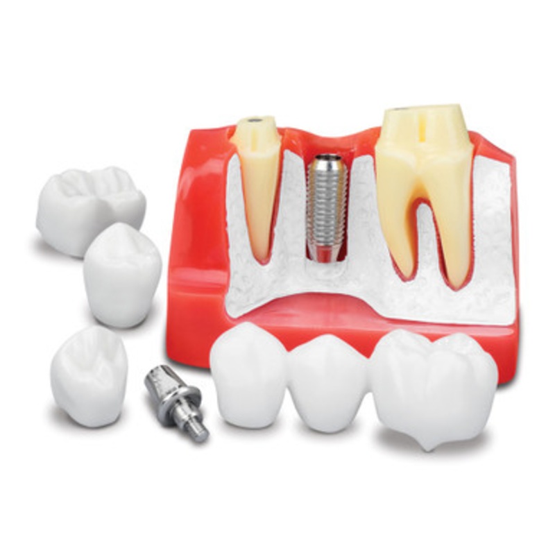 Implant Analysis Model