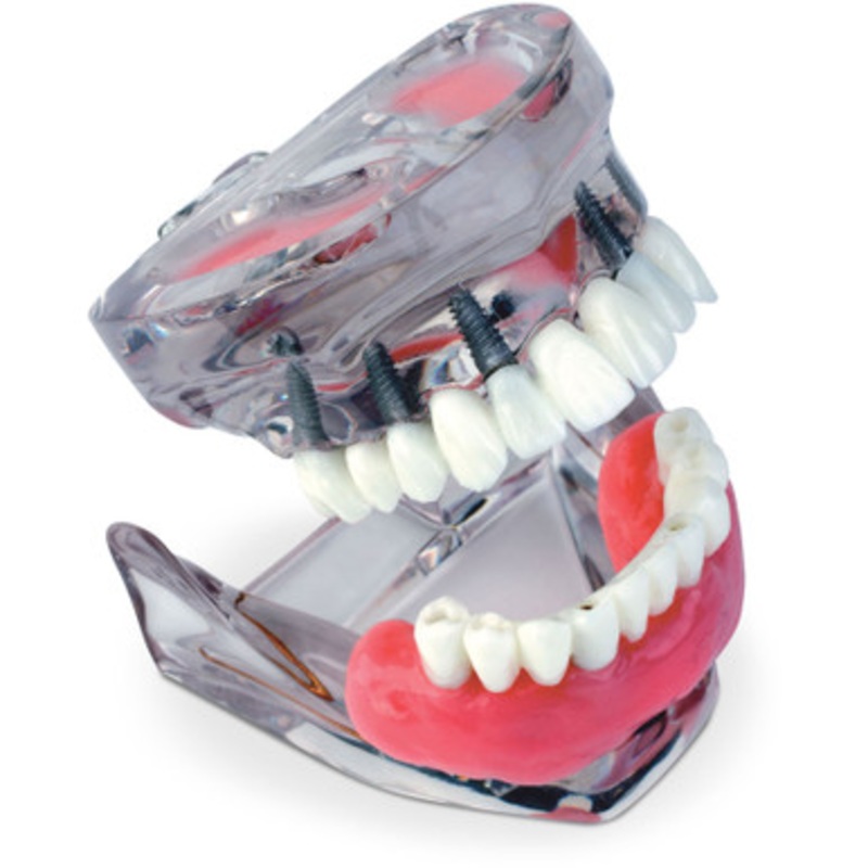 Dual Arch Implant Model