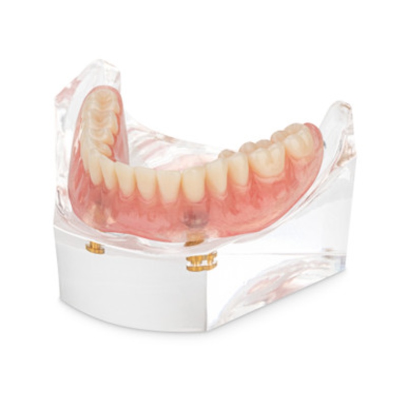 Locator Overdenture Model
